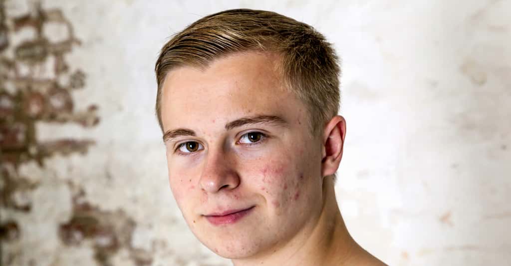 L'acné souvent un problème à l'adolescence. © Jorg Hackemann - Shutterstock